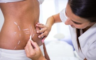 abdominoplastia