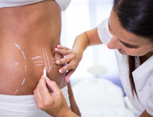 Abdominoplastia inversa o invertida: qué es y cuándo se recomienda