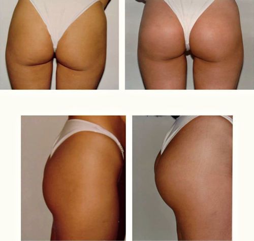 BBL - brazilian Butt Lift 