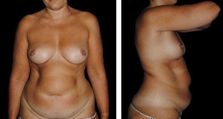 abdominoplastia antes y despues