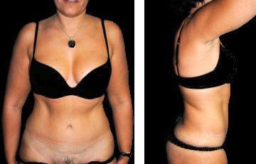 antes y después de una abdominoplastia