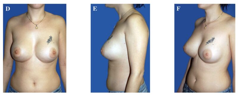 despues cirugia mamas tuberosas