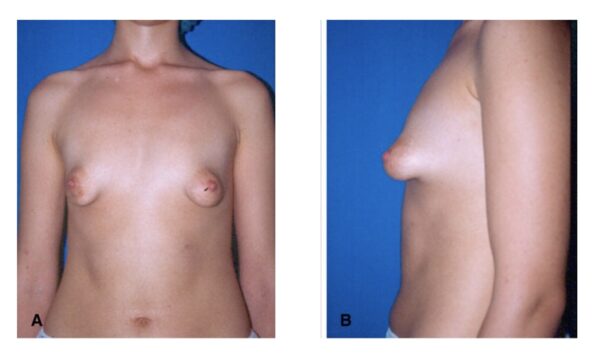 antes y después mamas tuberosas - Caso 1