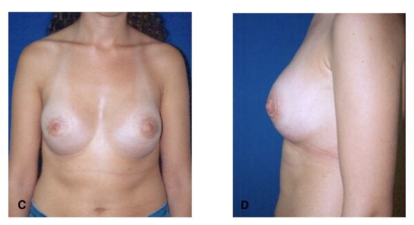 cirugia mamas tuberosas después