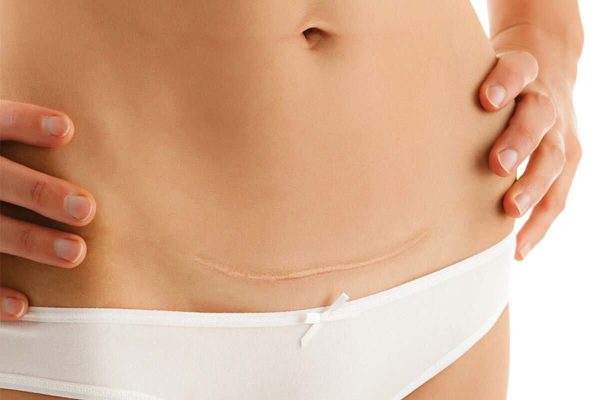 tipos de abdominoplastia
