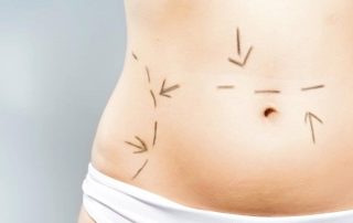 Tummy Tuck o abdominoplastia
