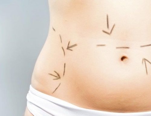 Fibrosis abdominal post liposucción: qué es, por qué aparece y cómo tratarla
