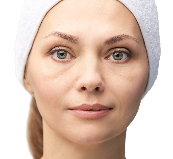 blefaroplastia