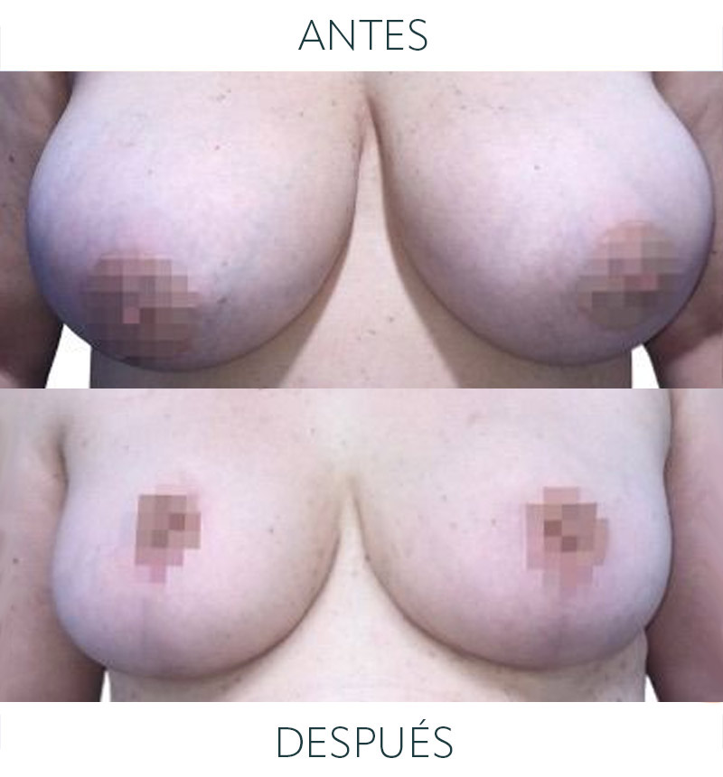 antes después reducción mamaria