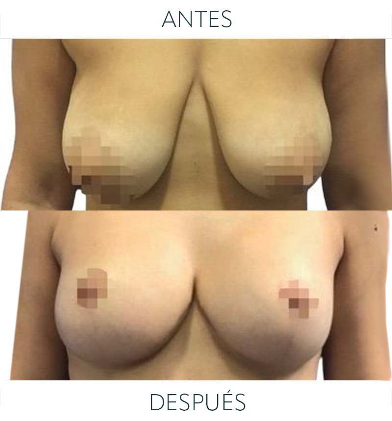 antes después reducción mamaria