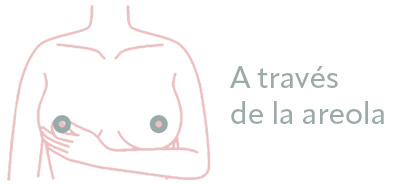aumento mamario areola