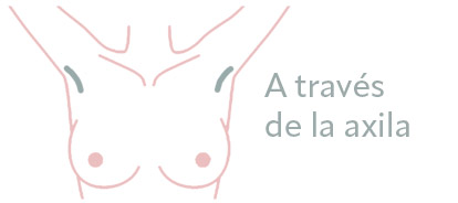 aumento mamario axilar