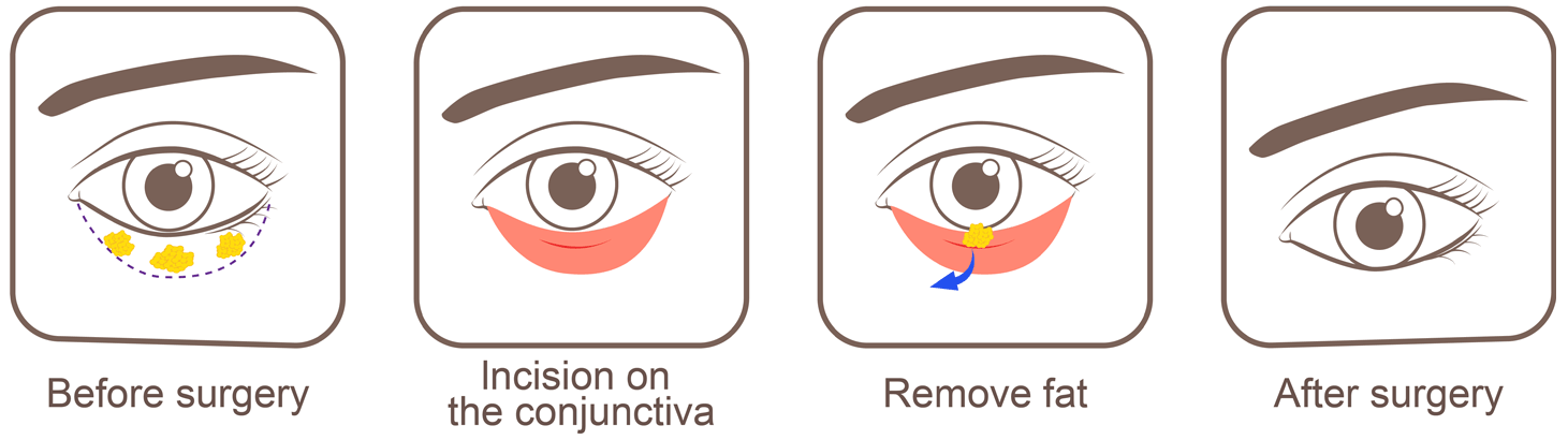 blefaroplastia inferior