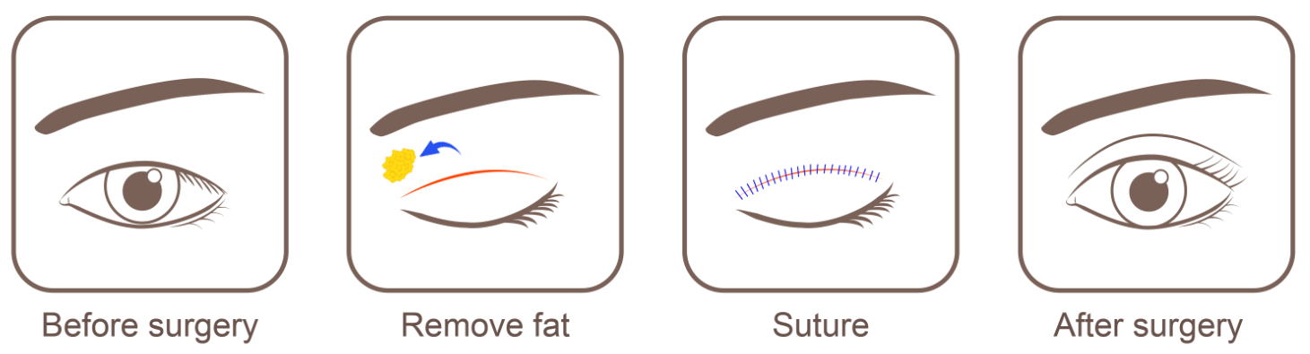 blefaroplastia superior