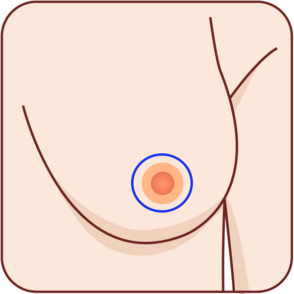 incisiones periareolares