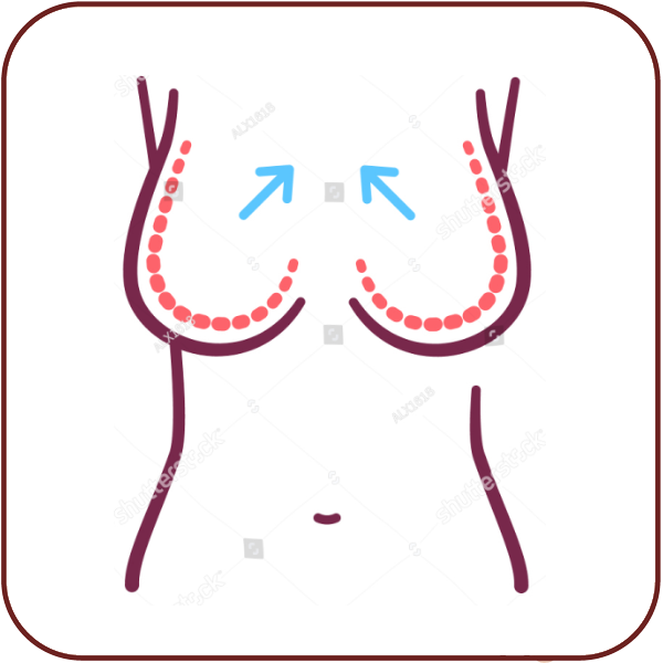 mamoplastia reducción
