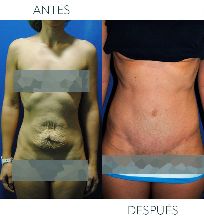abdominoplastia antes