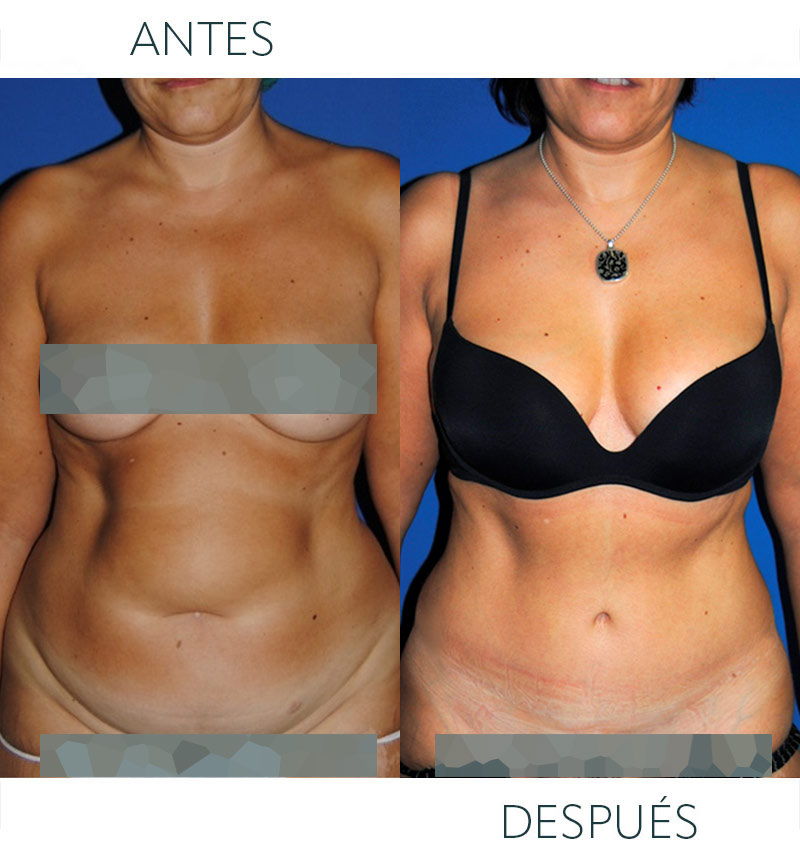 abdominoplastia antes 01