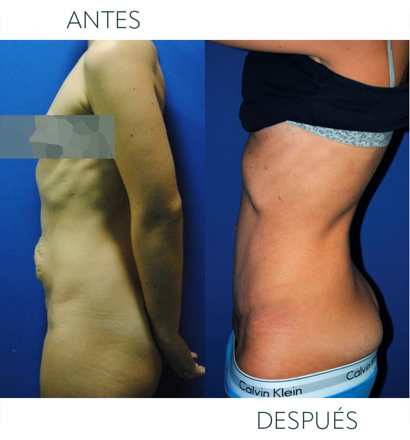 abdominoplastia después