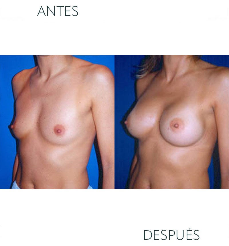 aumento mamario Barcelona antes