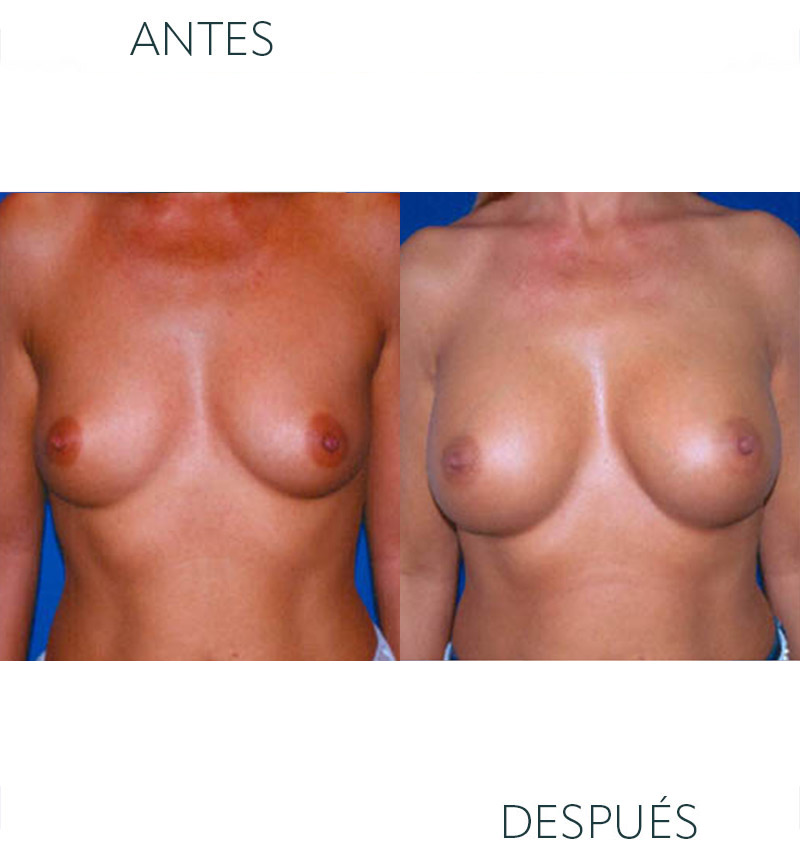 aumento de pecho en Barcelona antes y después