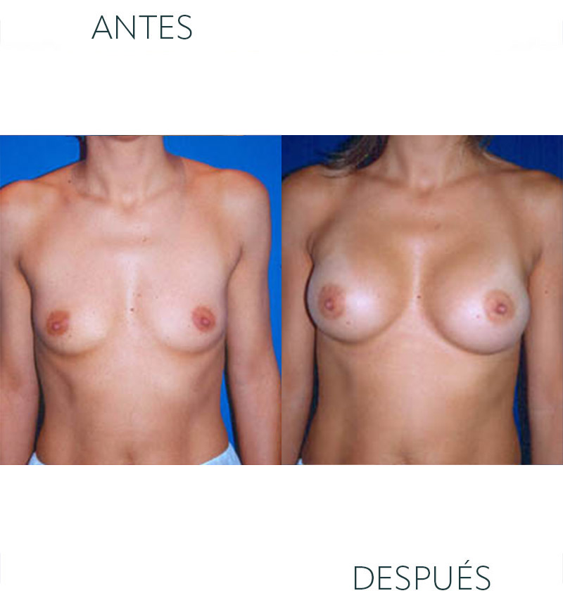 aumento de pecho antes y después