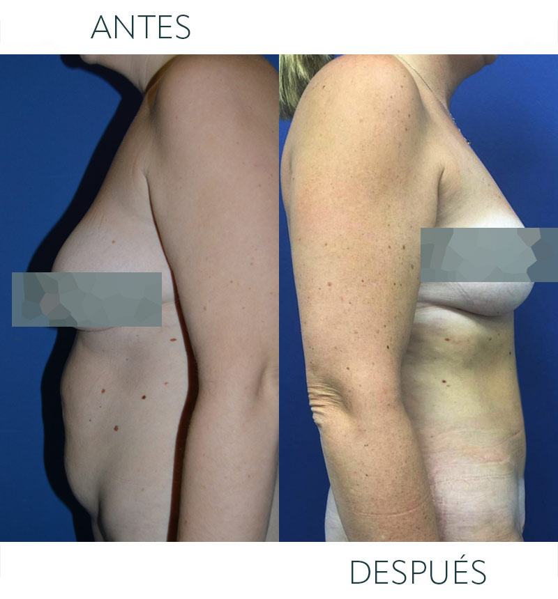 cirugía abdomen antes
