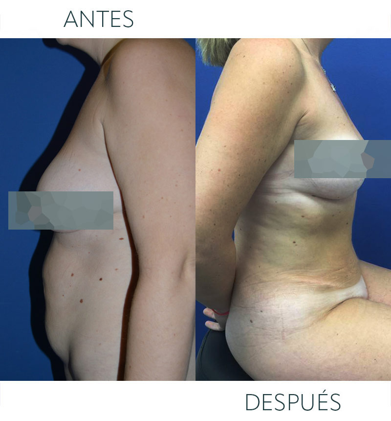 cirugía abdomen después