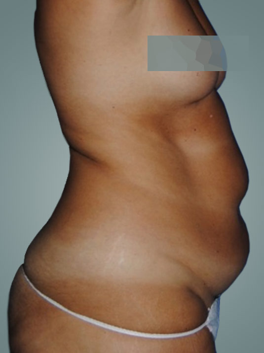cirugía abdomen