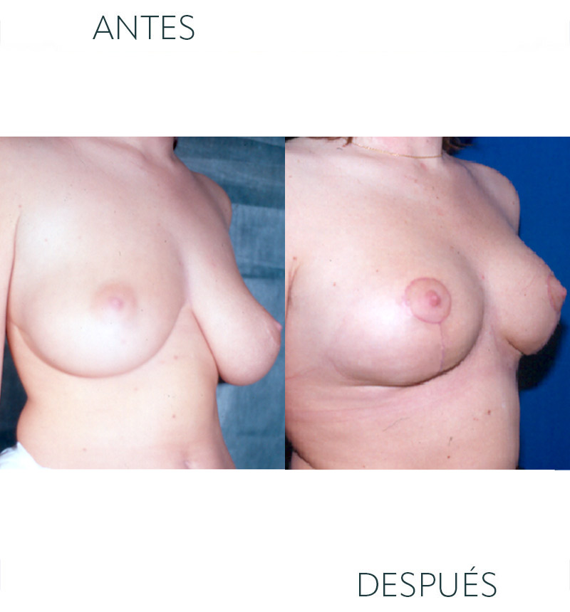 elevación pecho antes