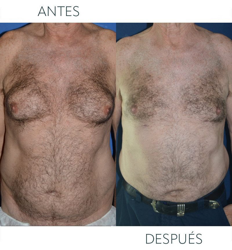 ginecomastia hombres antes después