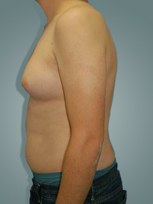 ginecoplastia masculina ginecomastia hombres antes y después