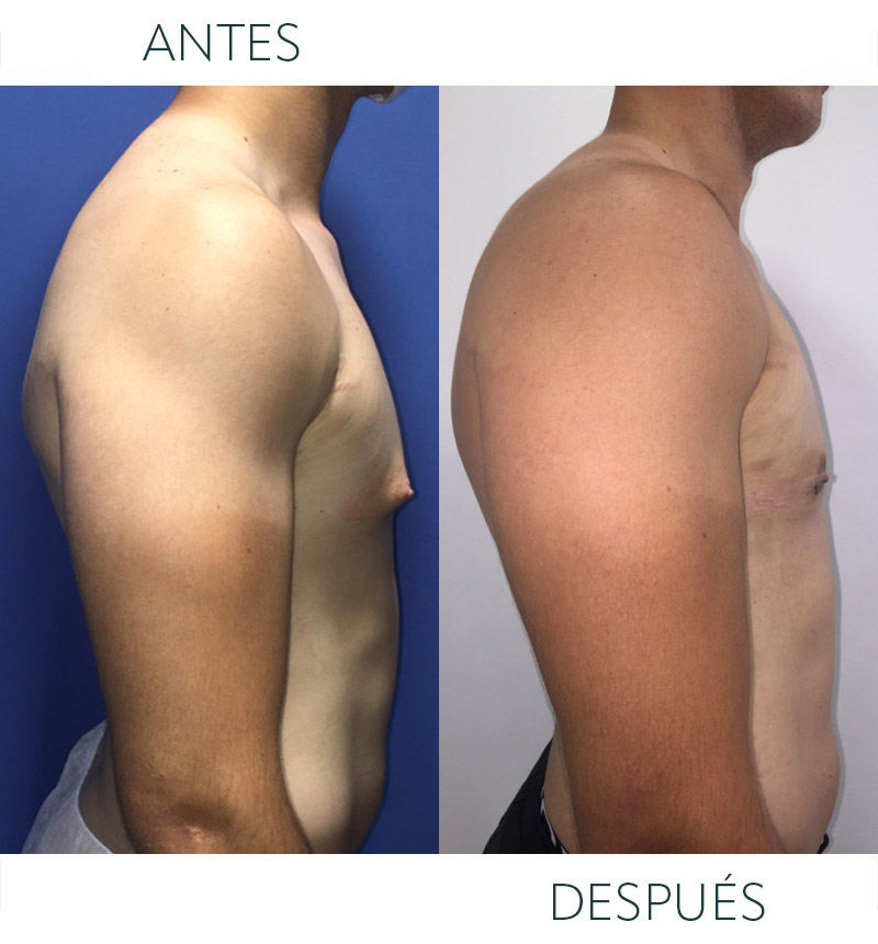 ginecomastia masculina antes después 01
