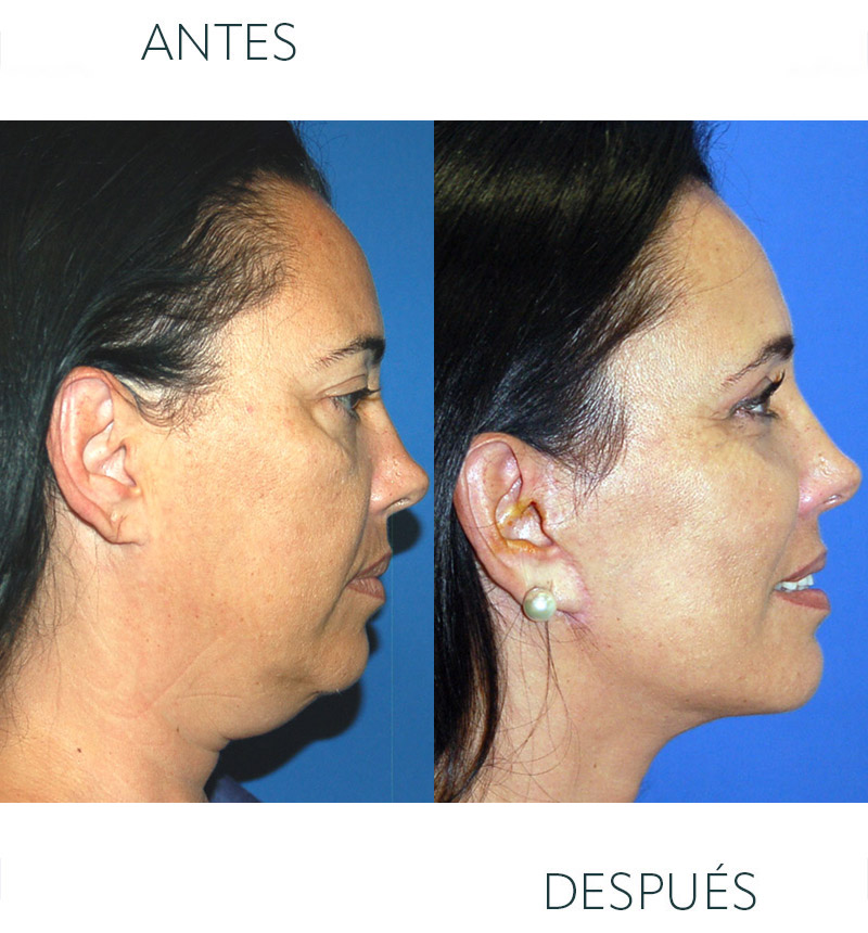 lifting facial Barcelona antes y después