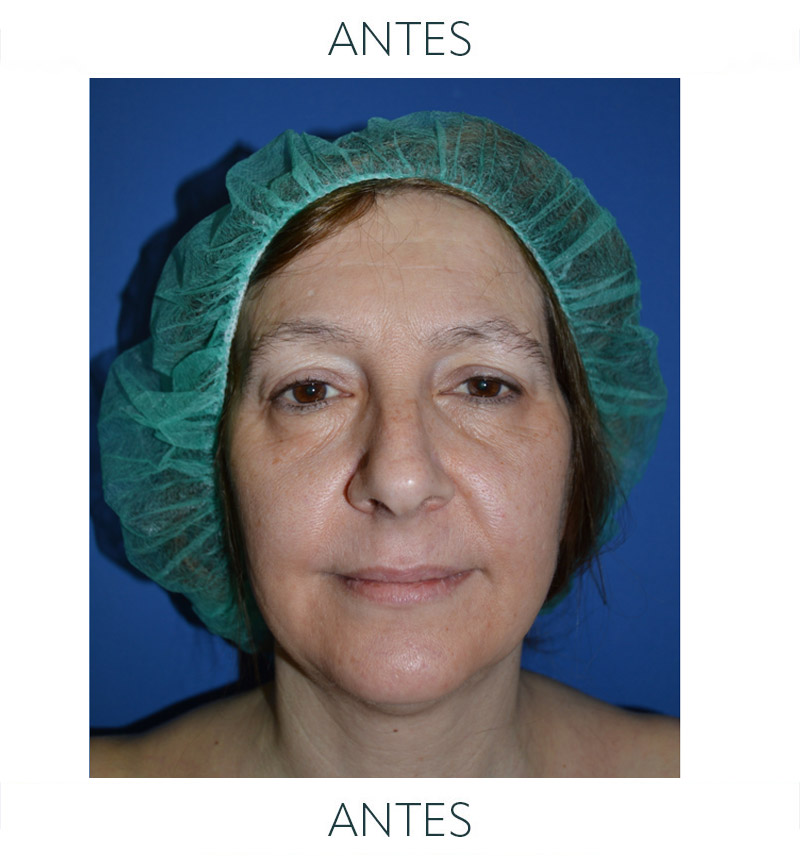 lipofilling antes