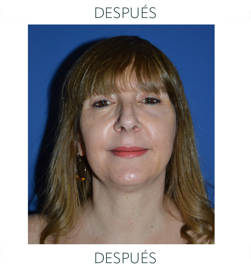 lipofilling después
