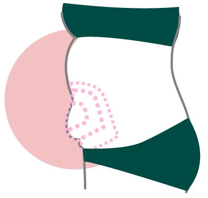 lipo abdomen