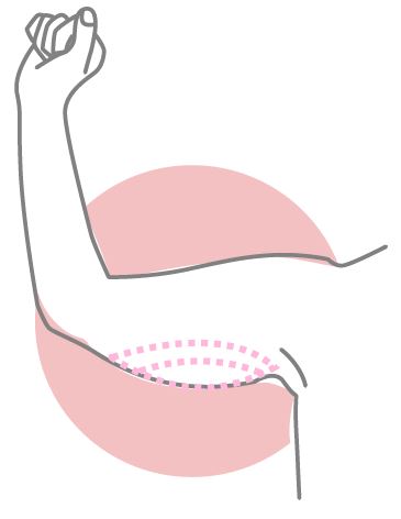 lipo de brazos