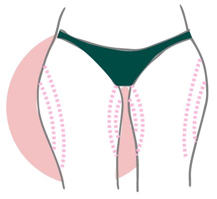 lipo muslos