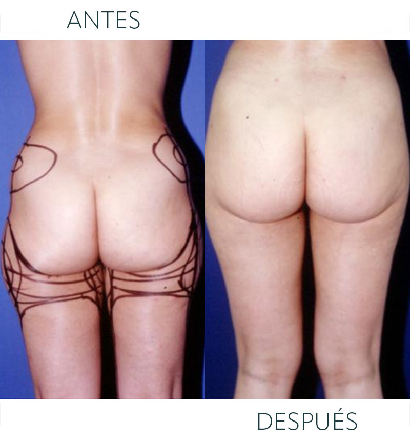 liposucción Barcelona antes