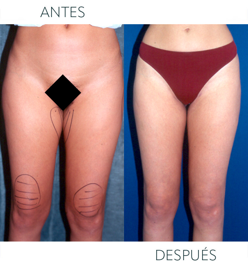 liposucción antes
