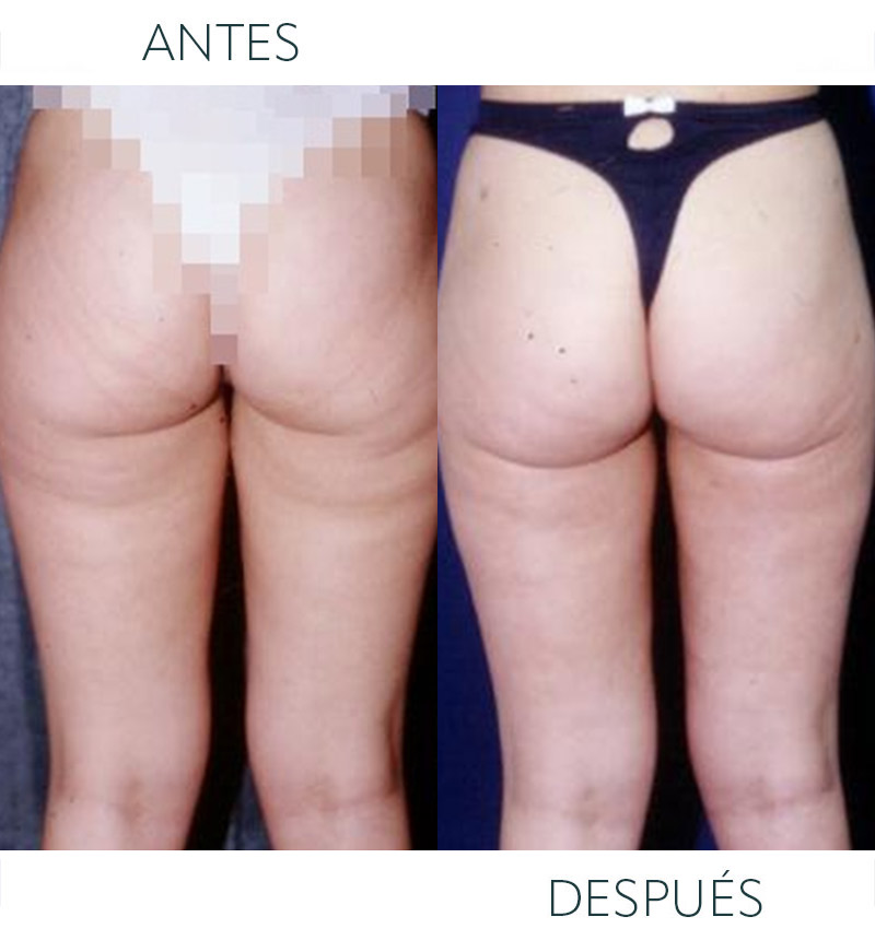 liposucción Barcelona después
