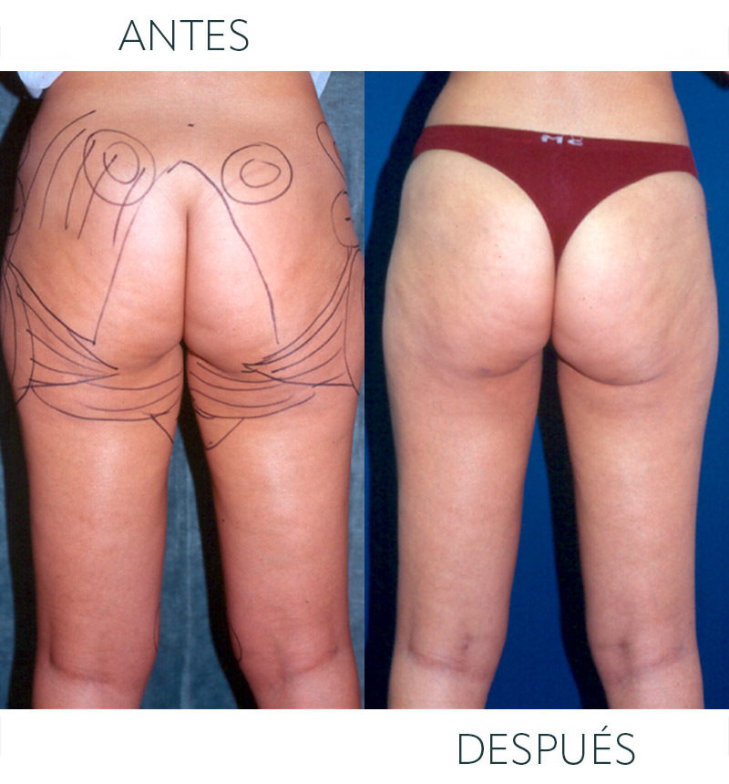 liposucción después