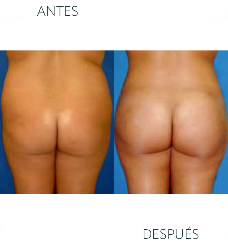 liposucción glúteos Barcelona antes y despues - lipotransferencia