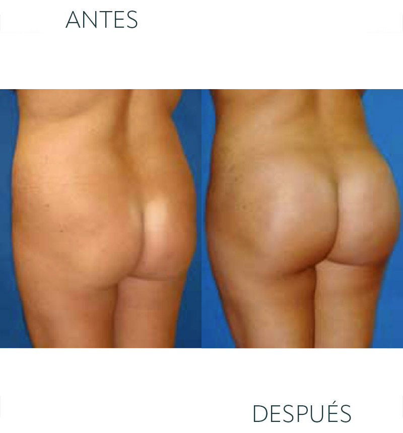 liposucción glúteos Barcelona y despues - lipotransferencia