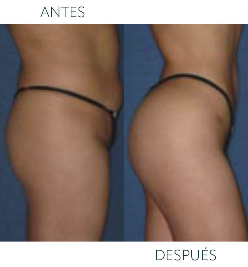 liposucción glúteos antes