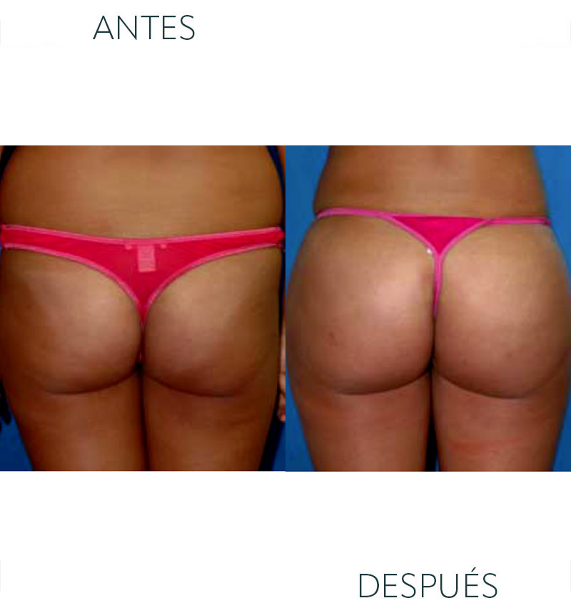 liposucción glúteos después