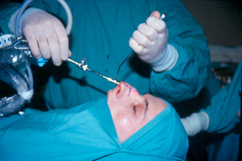 Mejores cirujanos en rinoplastia