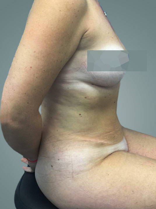técnica de plicatura muscular en abdominoplastia