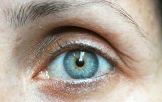 brow lift - lifting de cejas